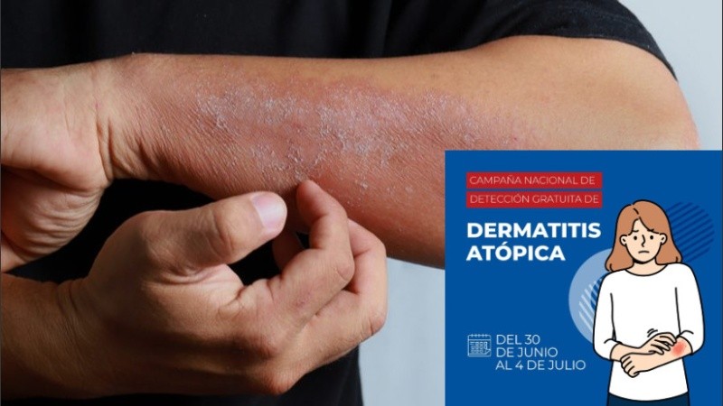 Atopik dermatit sık alevlenmeler yoğun kaşıntı tahriş ağrı kızarıklık kabuklanma 